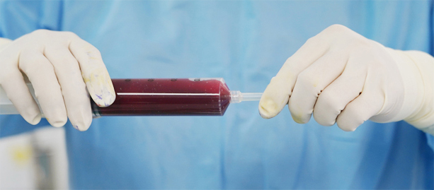 Bone marrow concentrate in a syringe, held by a clinician in the operating room