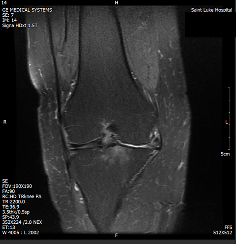 Knee MRI two years after treatment, May 2026