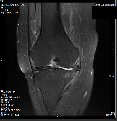 Knee MRI before treatment, April 2024