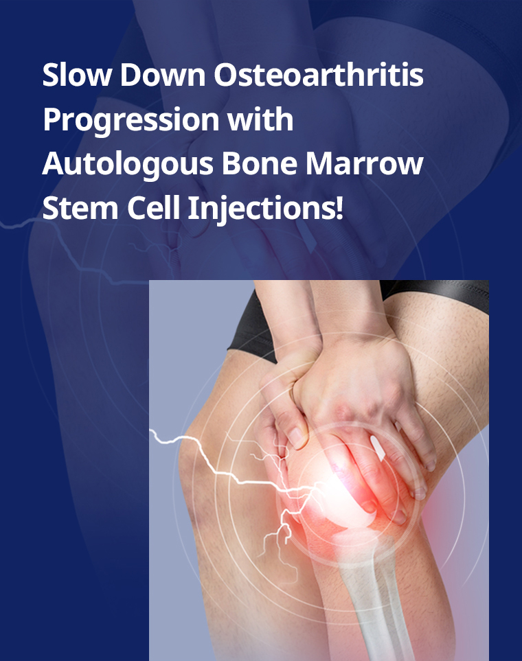 Slow down osteoarthritis progression with autologous bone marrow stem cell injections