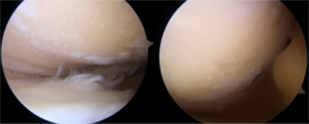 Knee arthroscopy before CARTISTEM treatment, January 2020