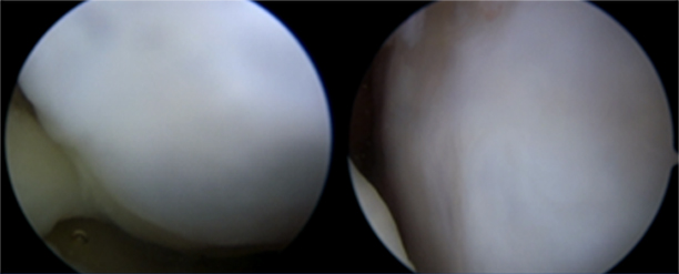 Knee arthroscopy one year after CARTISTEM treatment, August 2021