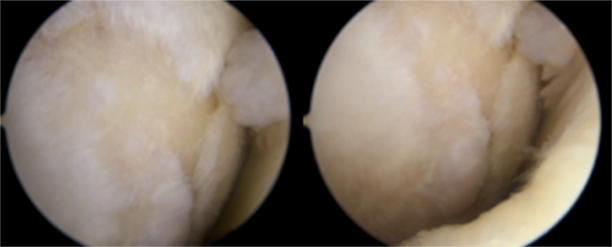 Knee arthroscopy before CARTISTEM treatment, July 2020