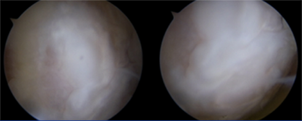Knee arthroscopy five years after CARTISTEM treatment, January 2025