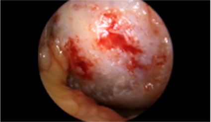 Knee arthroscopy before CARTISTEM treatment, June 2020