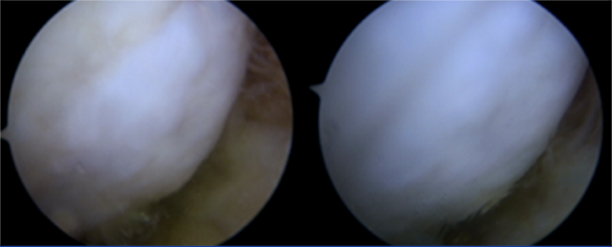 Knee arthroscopy three years after CARTISTEM treatment, January 2023