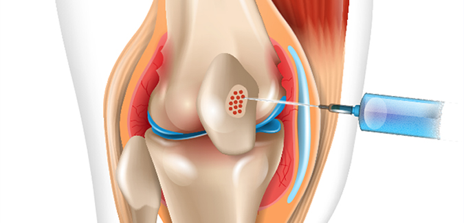 Illustration of a knee joint showing treatment applied to a cartilage defect