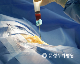 Bone marrow being aspirated from the anterior superior iliac spine in the operating room