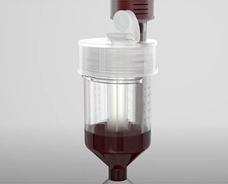 The aspirated bone marrow being transferred into the separation kit
