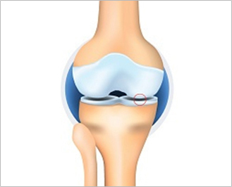 Illustration of a knee joint at Kellgren-Lawrence Grade 1