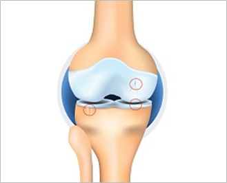 Illustration of a knee joint at Kellgren-Lawrence Grade 2