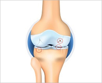 Illustration of a knee joint at Kellgren-Lawrence Grade 3