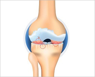 Illustration of a knee joint at Kellgren-Lawrence Grade 4
