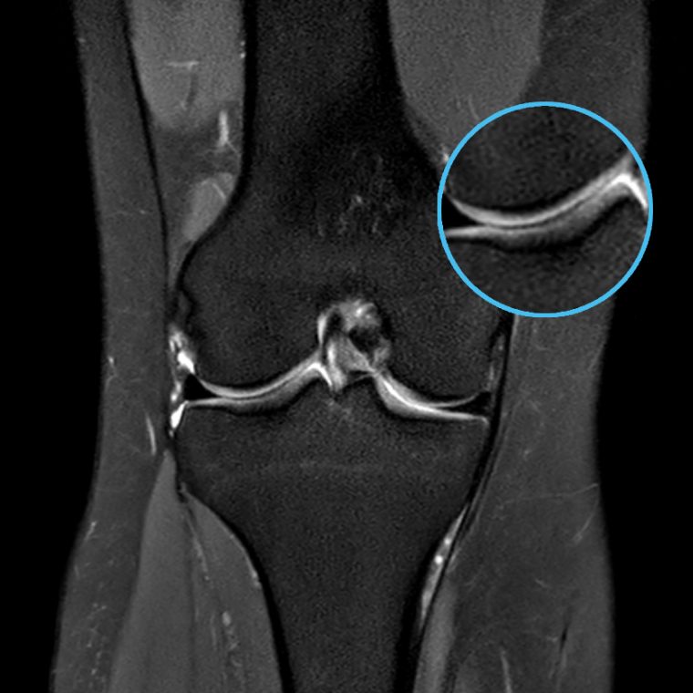Knee MRI acquired with a standard protocol
