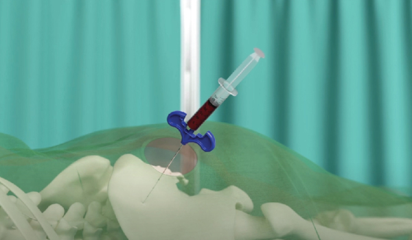 Illustration of bone marrow being aspirated from the pelvic bone with a needle and syringe